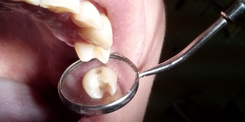 Реставрация зуба представлена материалом Kerr Herculite фото до лечения